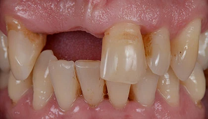 Before crown