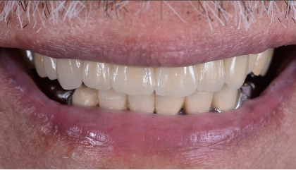 After dentures