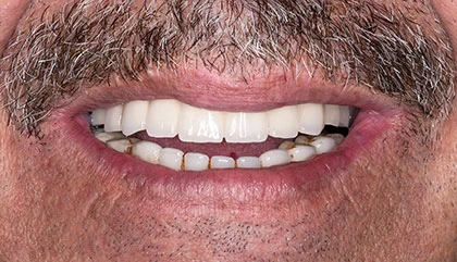 After dentures