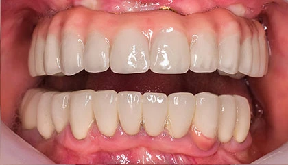 After dentures