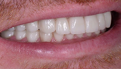After dentures
