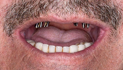 Before dentures