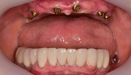 Before dentures