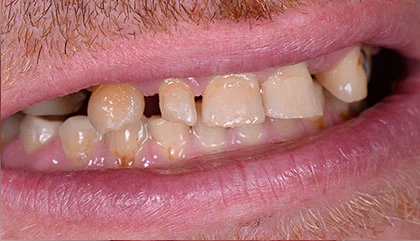 Before dentures