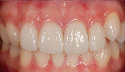 After treatment
