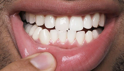 After treatment