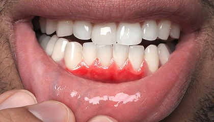 Before treatment