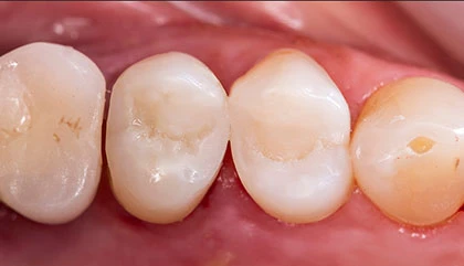 After filling