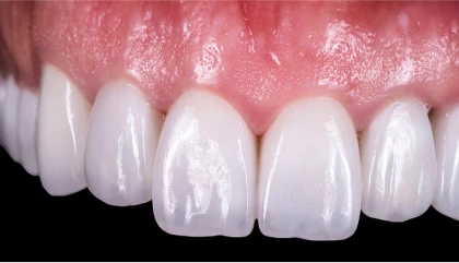 After implant