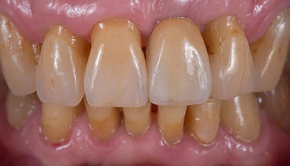After implant