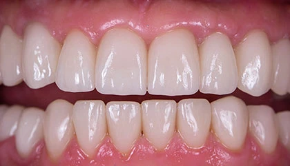After implant