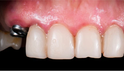 Before implant