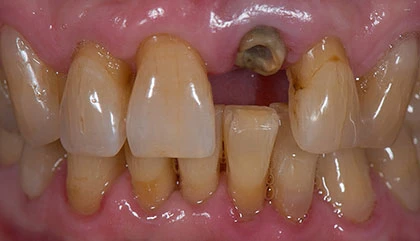 Before implant