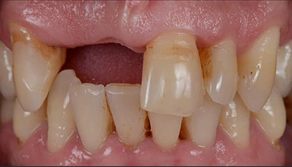 Before implant