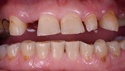 Before implant