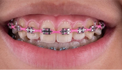 After orthodontic treatment