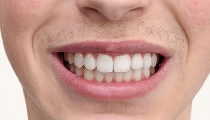 After orthodontic treatment