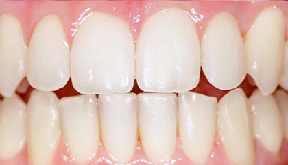 After orthodontic treatment