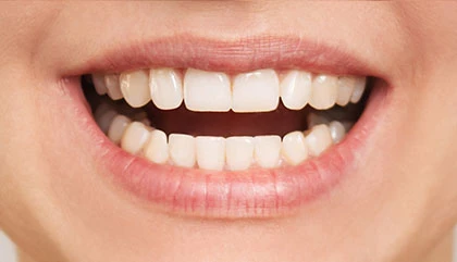 After orthodontic treatment