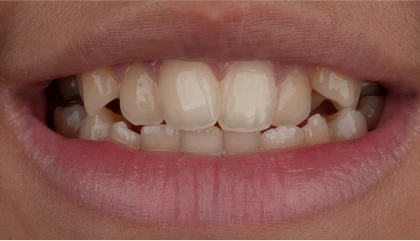 Before orthodontic treatment