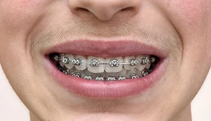 Before orthodontic treatment