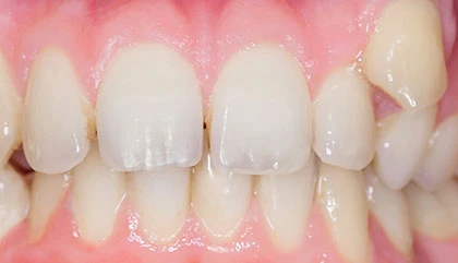 Before orthodontic treatment