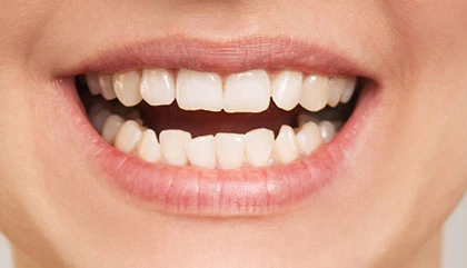 Before orthodontic treatment