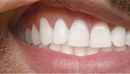After root canal