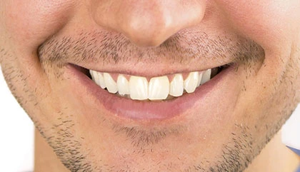 After root canal