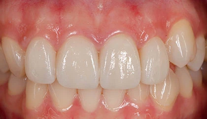 After root canal