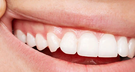 After root canal
