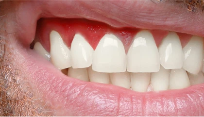 Before root canal
