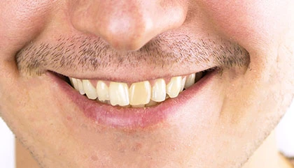 Before root canal