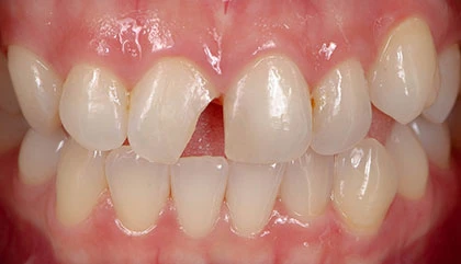 Before root canal
