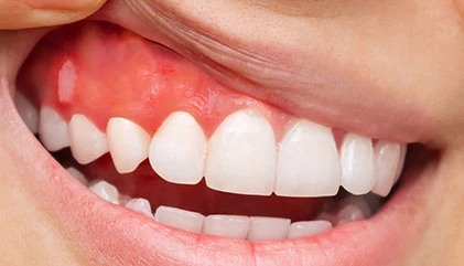 Before root canal