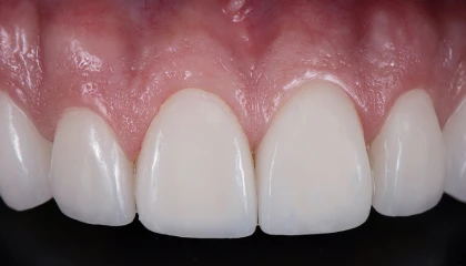 After veneers