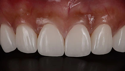 After veneers