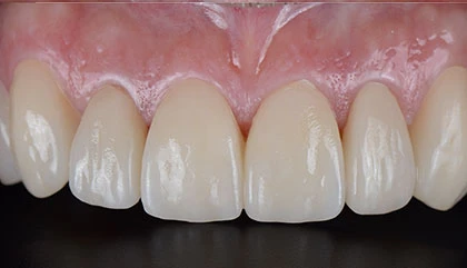 After veneers