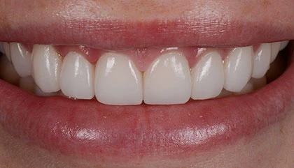 After veneers