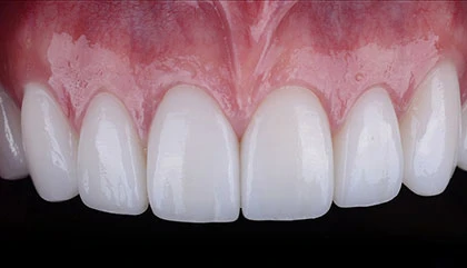 After veneers