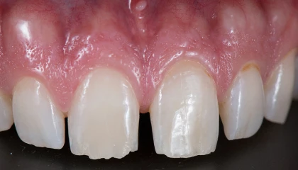 Before veneers