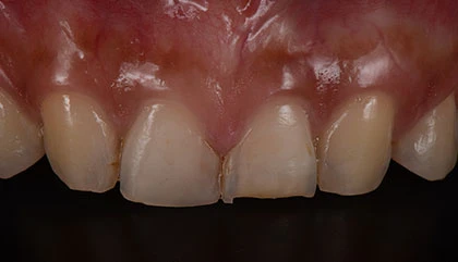 Before veneers