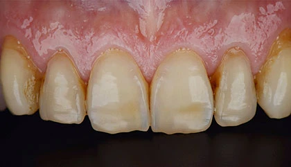 Before veneers