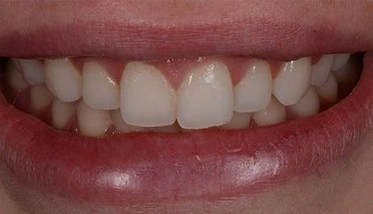 Before veneers