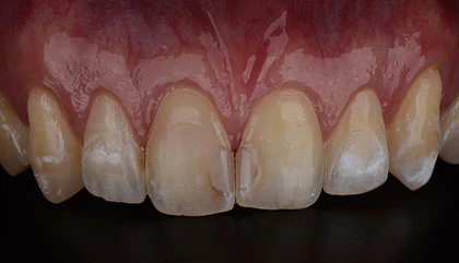 Before veneers