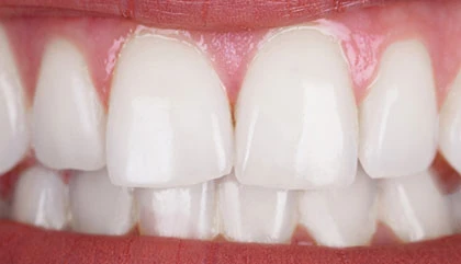 After whitening