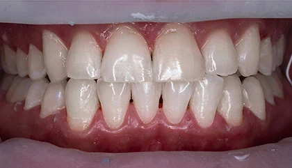 After whitening