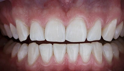 After whitening