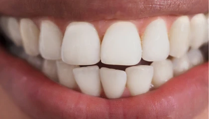 After whitening