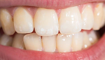 Before whitening
